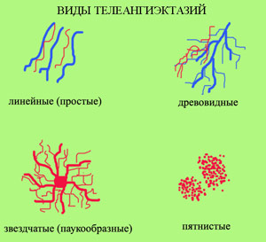 Виды телеангиэктазий