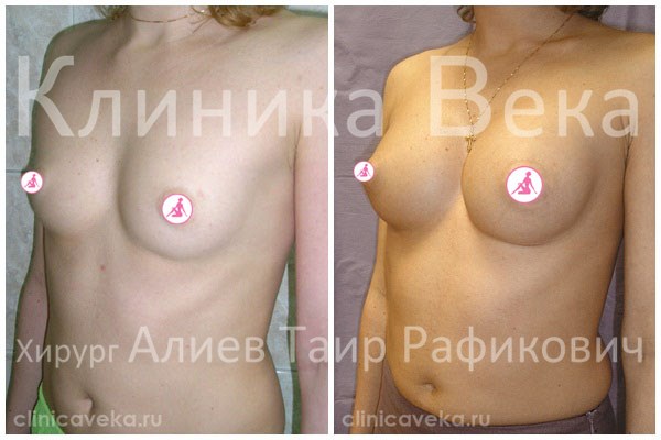 Силиконовая грудь примеры