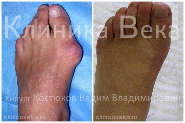 Какую обувь нежелательно носить если на ногах косточки