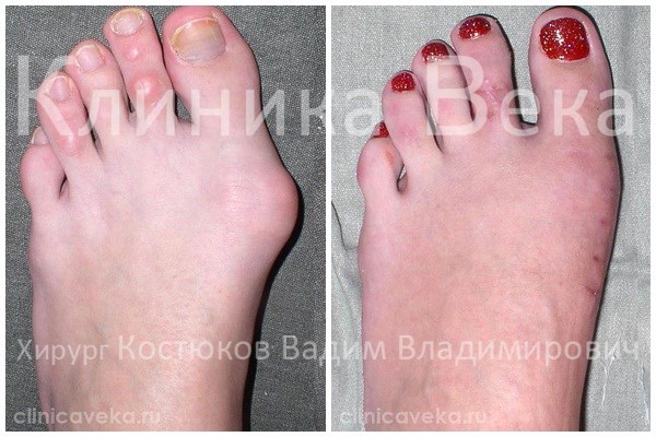 Отзывы про лечение косточки на большом пальце ноги