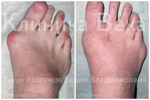 Форум Как избавиться от косточки на ноге (вальгусной деформации стопы)