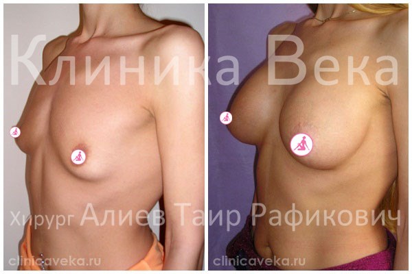 увеличение правой груди увеличение правой груди