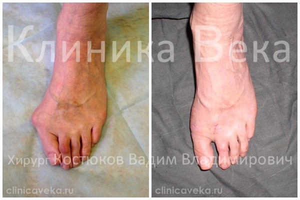Удаление косточек на ногах после операции на