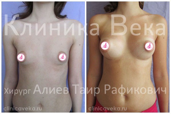 Народное методика увеличения груди бесплатно