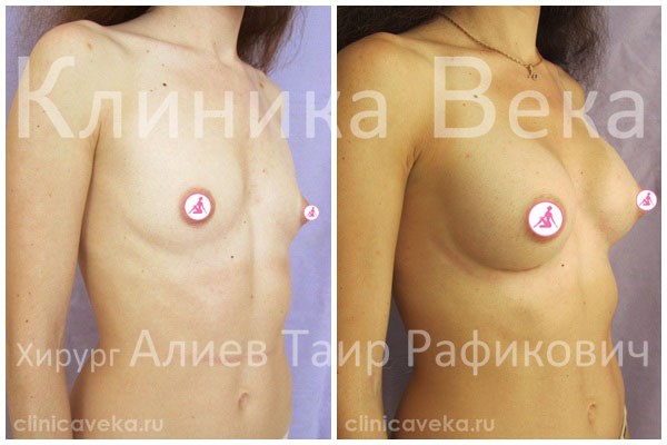 Можно ли с помощью физических упражнений увеличить грудь