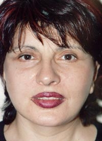 Подтяжка лица — После операции