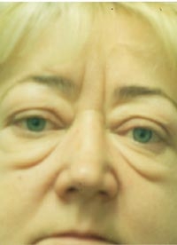 Пластика век — блефаропластика — До операции