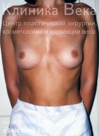 Увеличение груди — До операции