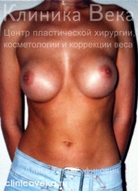 Увеличение груди — Через 2 месяца после операции