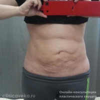 Здравствуйте доктор. У меня была неудачная липосакция живота