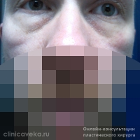 Я хотел бы убрать мешки на скулах и мешки под глазами