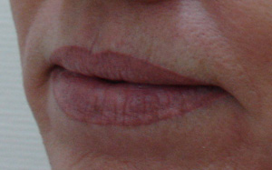 Фотография до До инъекции AlloDerm