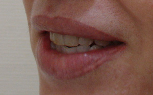 Фотография после До инъекции AlloDerm