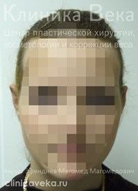 Пластика ушей — Через 10 дней после