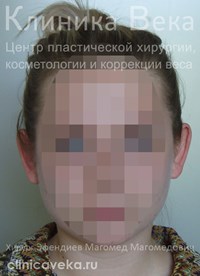 Отопластика — пластика ушных раковин — До пластики ушей