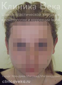 Отопластика — пластика ушных раковин — Через 10 дней после