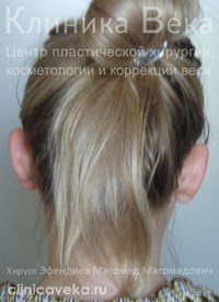 Отопластика — пластика ушных раковин — До пластики ушей