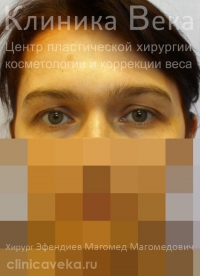 Эндоскопическая подтяжка лба — До