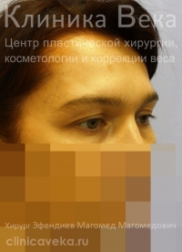 Эндоскопическая подтяжка лба — До