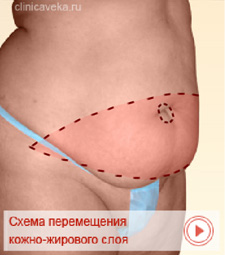 Пластика живота