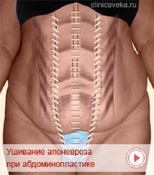 Ушивание апоневрозов при пластике живота